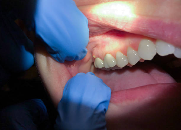 Best Emergency Broken Tooth Repair in Dalton, GA